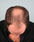 Before Hair Transplant &nbsp;Midscalp